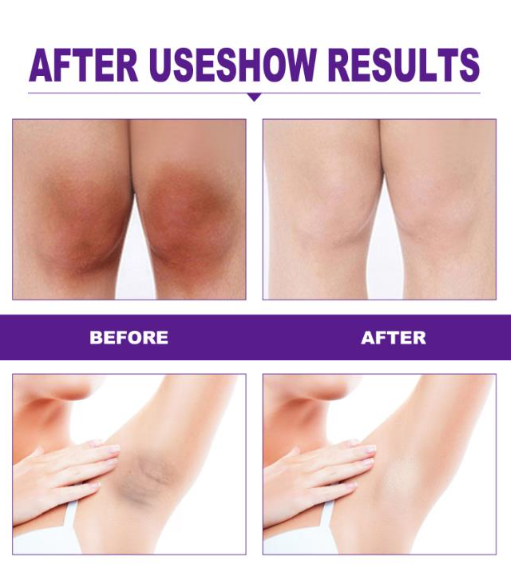 Skin Brightening Cream for Women Private Parts Lightening Cream Underarm Thigh Dark Bleach Serum Remove Melanin Brighten Cream