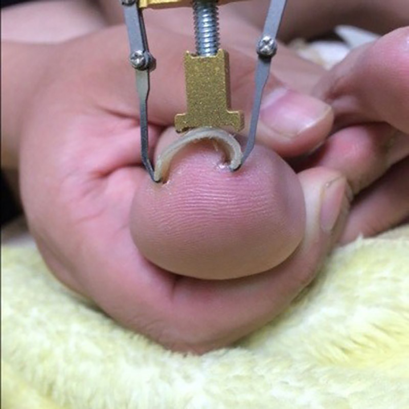 1PC Straightening Clip Ingrown Toenail Corrector Pedicure Foot Nail Care Tools Stainless Steel Pedicure Treatment Correction