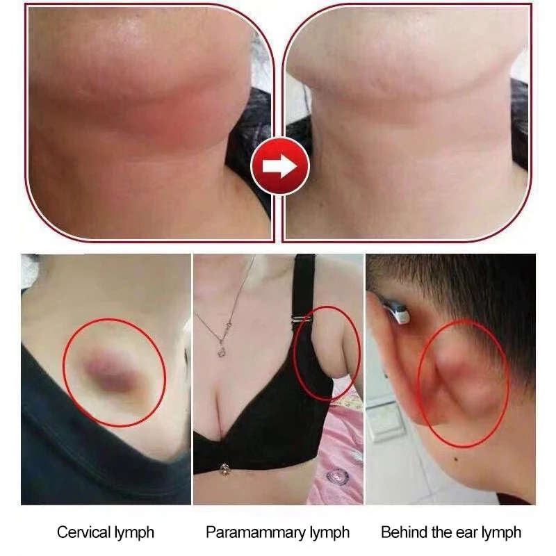 10PCS Herbal Lymphatic Detox Patch Neck Anti-Swelling Lymph Node Herbal Pads Medical Plaster Breast Patch Health Care