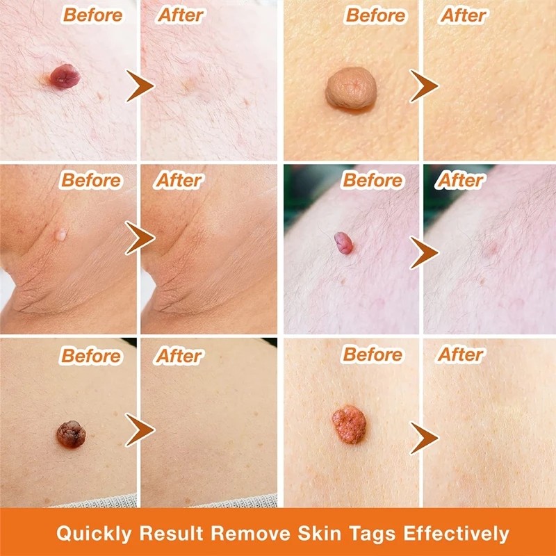 Wart Removal Treatment Antibacterial Ointment Papillomas Removing Skin Labels Flat Wart Genitals Painless Beauty Herbal Cream