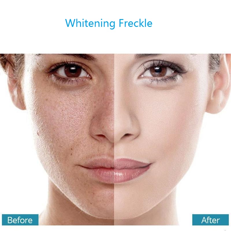Whitening Freckle Cream Remove Melasma Acne Spot Pigment Melanin Dark Spots Pigmentation Freckle Removal Cream Moisturizing Gel