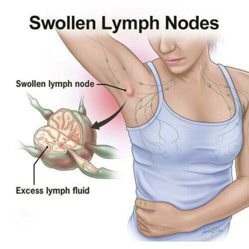 10PCS/pack Herbal Lymph Care Patch Neck Anti-Swelling Sticker Breast Lymph Node