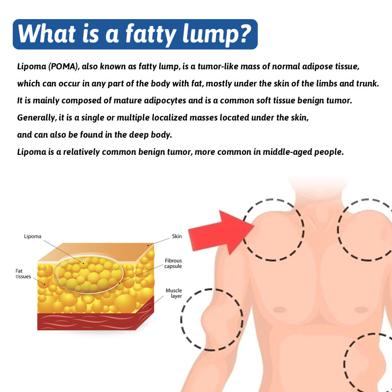 South Moon Fat Nodule Cream Relieves Fat Lumps and Hard Bulges, Eliminates Tumor Cream Improves Fat Nodules Cream