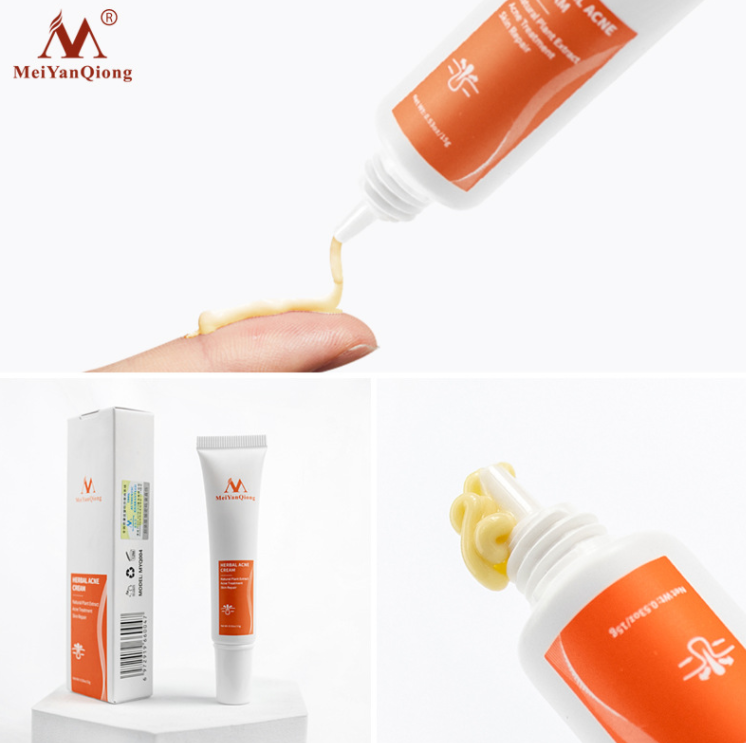 Face Acne Cleaning Cream Skin Care Remove Repair Comedone Pimple Acne Quickly Face Acne Cream Remover Anti Acne Treatment