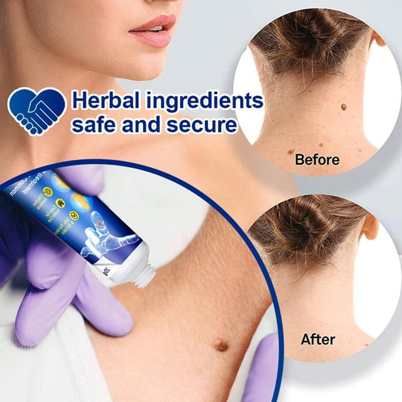Skin Tag Wart Removal Treatment Neck Facial Foot Wart Removal Cream Target Mole Ointment Wart Removal Medical Plaster