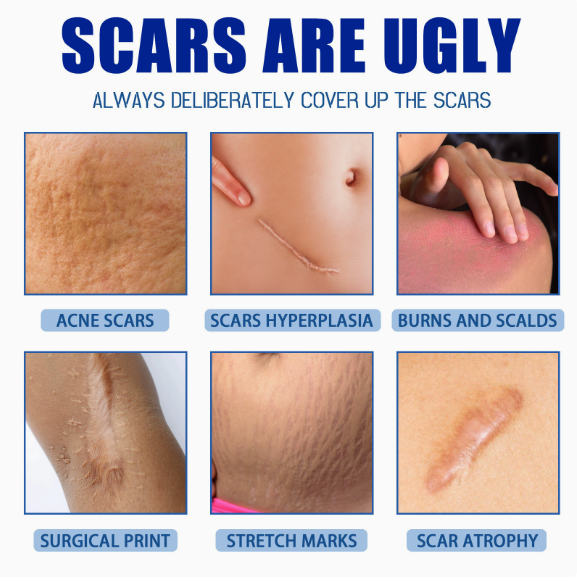 5-Day Recovery Scar Cream Fast Removal Skin Scars Treat Surgery Scars Stretch Marks Acne Pox Prints Burn Repair Facial Care Gel