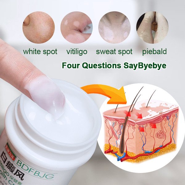 30G Vitiligo cream Antibacterial cream Psoriasis Localised Vitiligo Zalf White spot Mycosis Leucoplasia Treatment P1153
