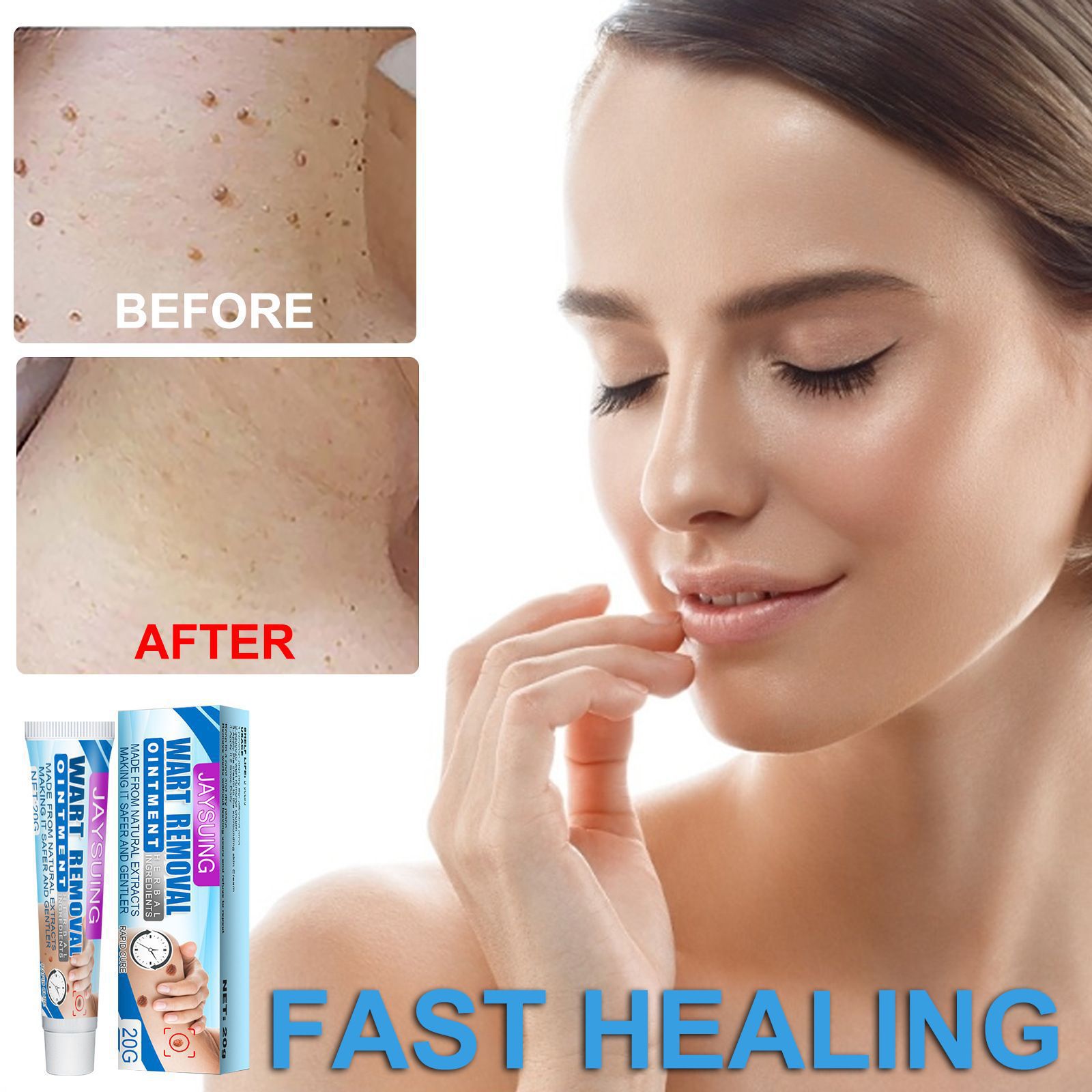 20ml Fast Removal Genital Wart Acne Spot Treatment Skin Tag Remover Against Mole & Genital Wart Fast Rapidly Removes Moles