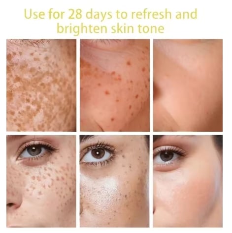 Powerful Dark Spots Remover Whitening Serum Face Freckle Melanin Correcting Anti Pigmentation Brighten Skin Beauty Care Essence