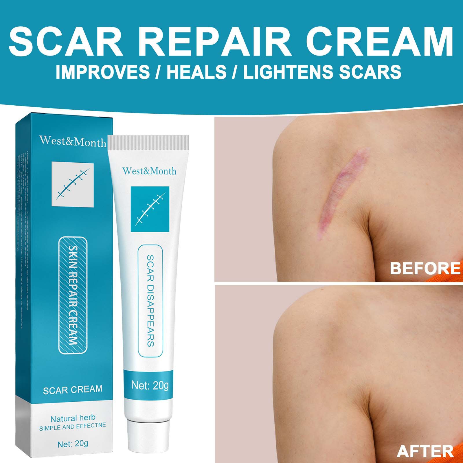 Herbal Scar Removal Cream Gel Stretch Marks Remove Acne Spots Burn Surgical Scars Treatment Smooth Whitening Face Body Skin Care