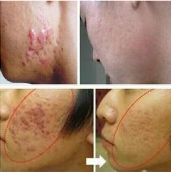 LANBENA 30ml Acne Scar Removal Cream Skin Repair Face Cream Acne Spots Acne Treatment Blackhead Whitening Cream Stretch Marks