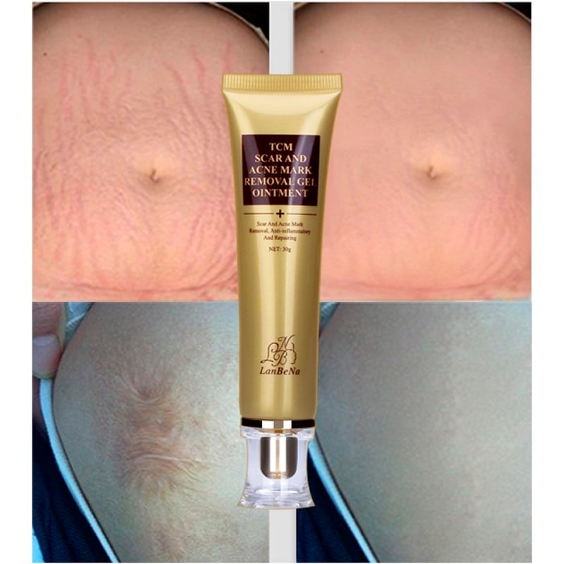 LANBENA 30ml Acne Scar Removal Cream Skin Repair Face Cream Acne Spots Acne Treatment Blackhead Whitening Cream Stretch Marks