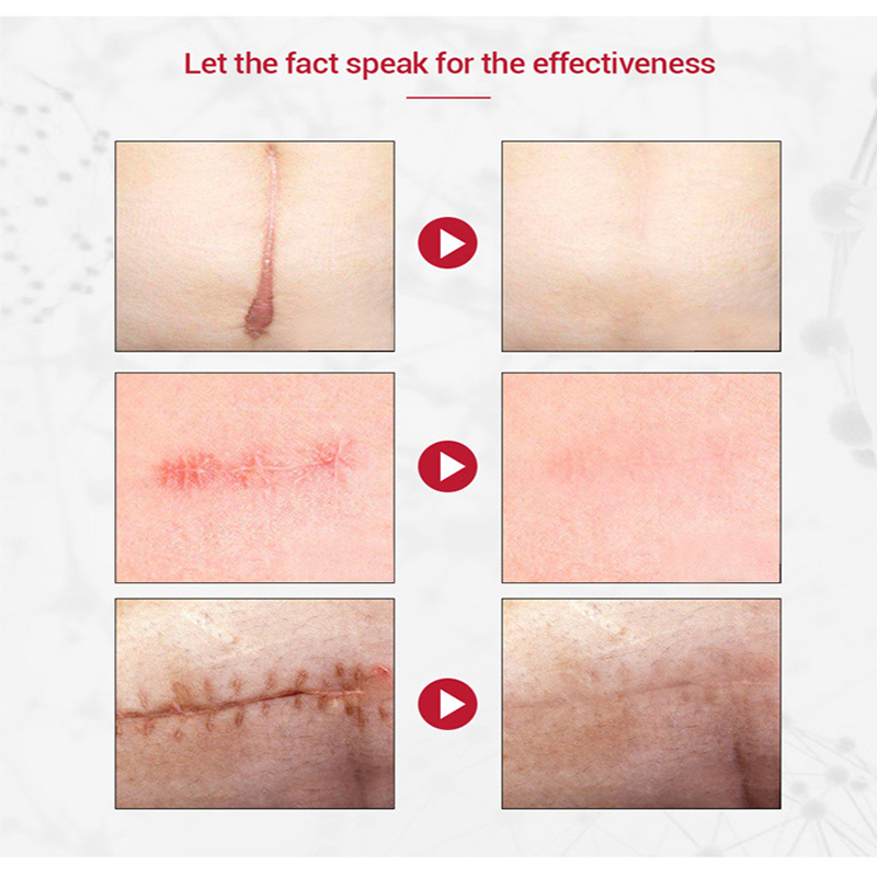 Herbal Scar Removal Cream Gel Repairing Pock Mark Burn Surgical Scar Cesarean Scar Stretch Marks Smooth Moisturizing Skin Care