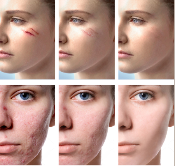 VIBRANT GLAMOUR Repair Scar cream Removal Acne Scars Stretch Marks CreamSurgical scar Burn For Body Pigmentation Corrector care