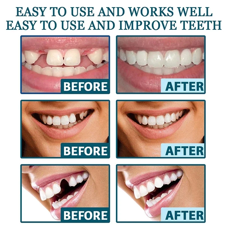 Whitening Tooth Denture Resin Temporary Teeth Braces Teeth Adjustable Denture Teeth Set Instant Smiling Denture Teeth Veneer