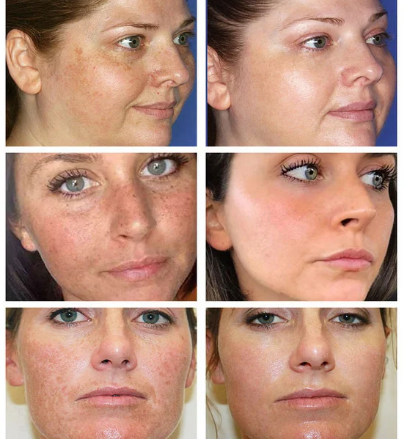 Effective Whitening Cream To Remove Melasma Acne Spot Pigment Melanin Black Spot Pigmentation Moisturizing Cream