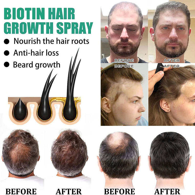 Hair Nourishing Liquid Spray Can Promote the Rapid Growth of Hair, Prevent Baldness, Treat Scalp and Beard, 20ml