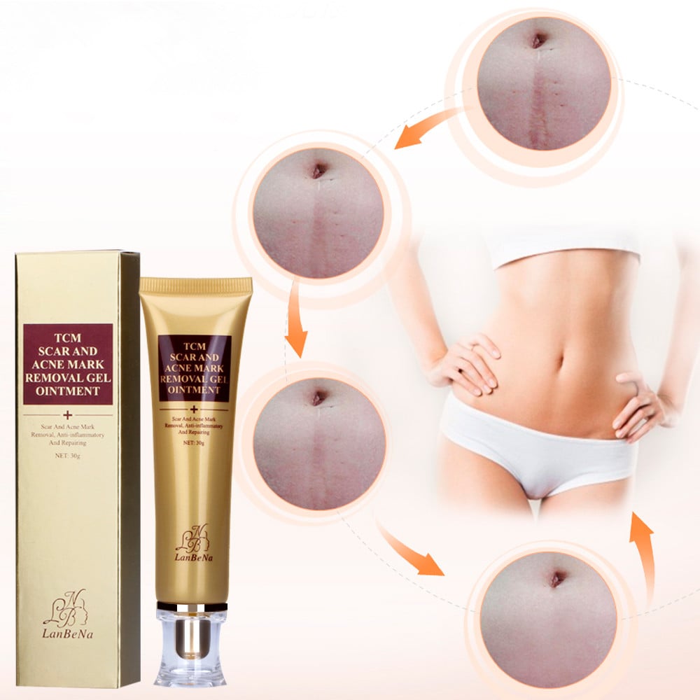 LANBENA 30ml Acne Scar Removal Cream Skin Repair Face Cream Acne Spots Acne Treatment Blackhead Whitening Cream Stretch Marks