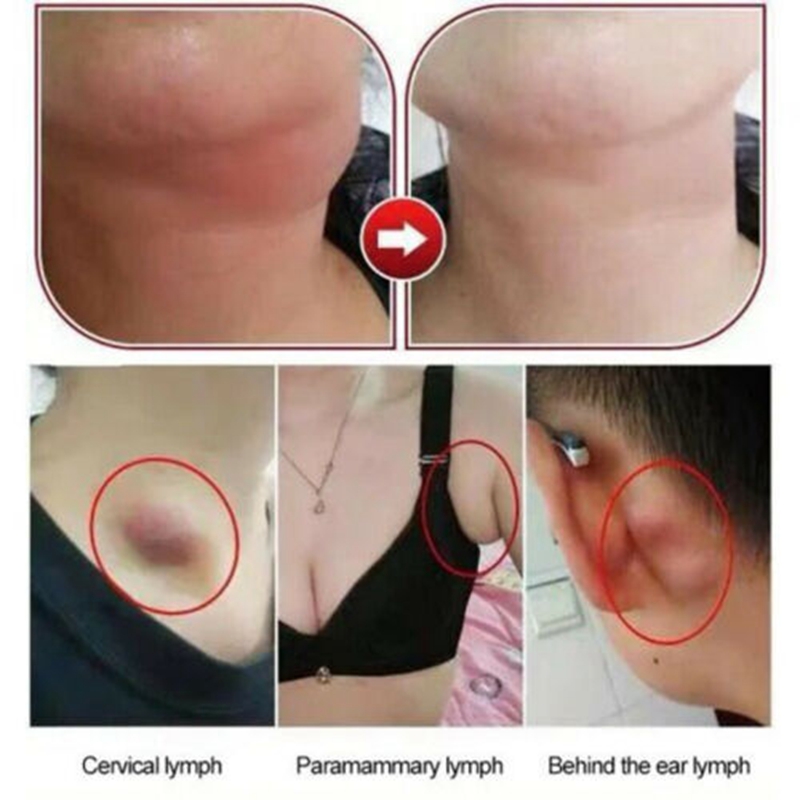 10PCS/pack Herbal Lymph Care Patch Neck Anti-Swelling Sticker Breast Lymph Node