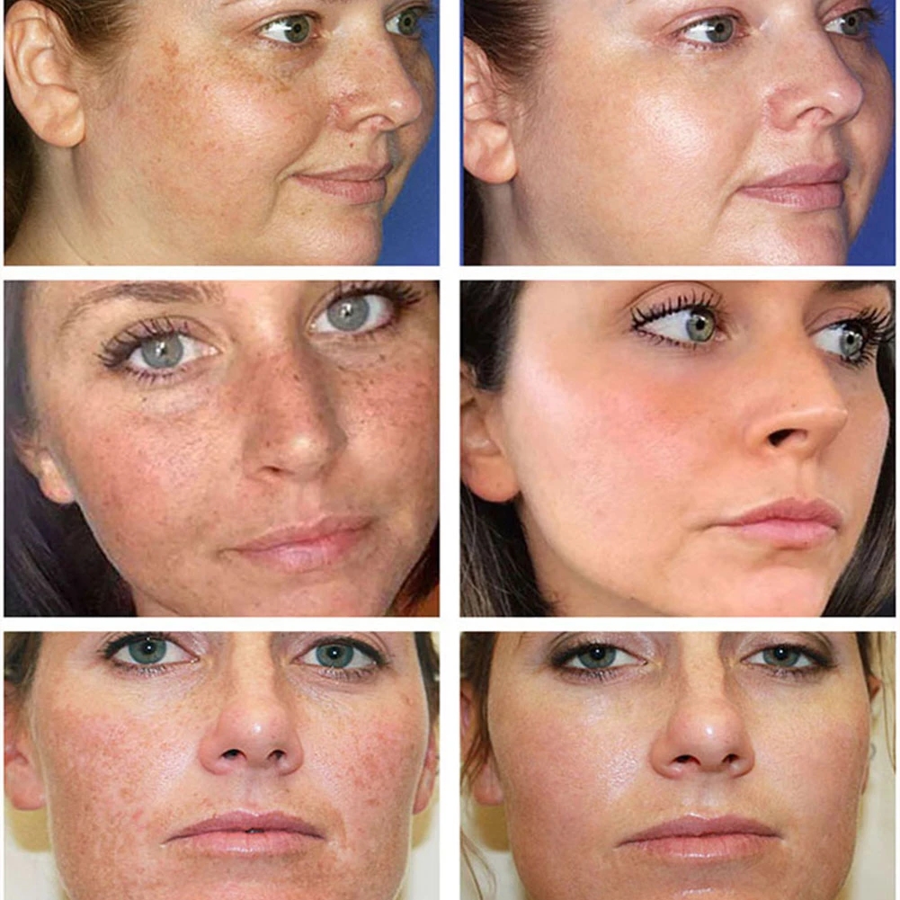 VOVA Effective Whitening Freckle Cream Rich in Vitamin C for Removing Melasma Acne Dark Spots Pigmentation Moisturizing Gel