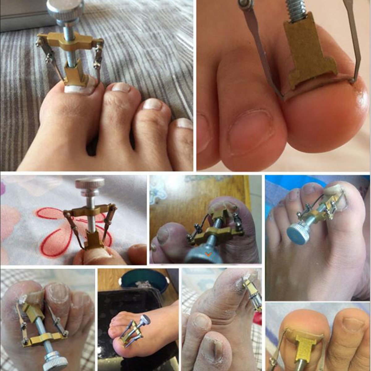 1PC Straightening Clip Ingrown Toenail Corrector Pedicure Foot Nail Care Tools Stainless Steel Pedicure Treatment Correction
