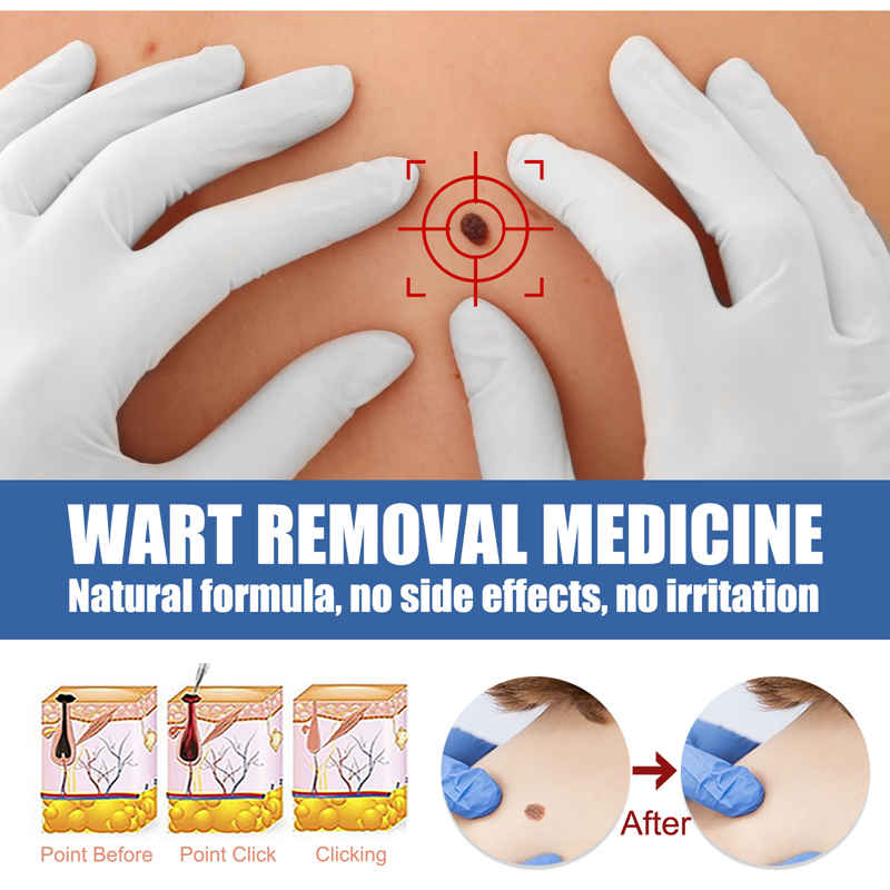 Skin Tag Remover Cream Painless Mole Skin Dark Spot Warts Remover Serum Freckle Face Wart Tag Treatment Removal Essential OIL