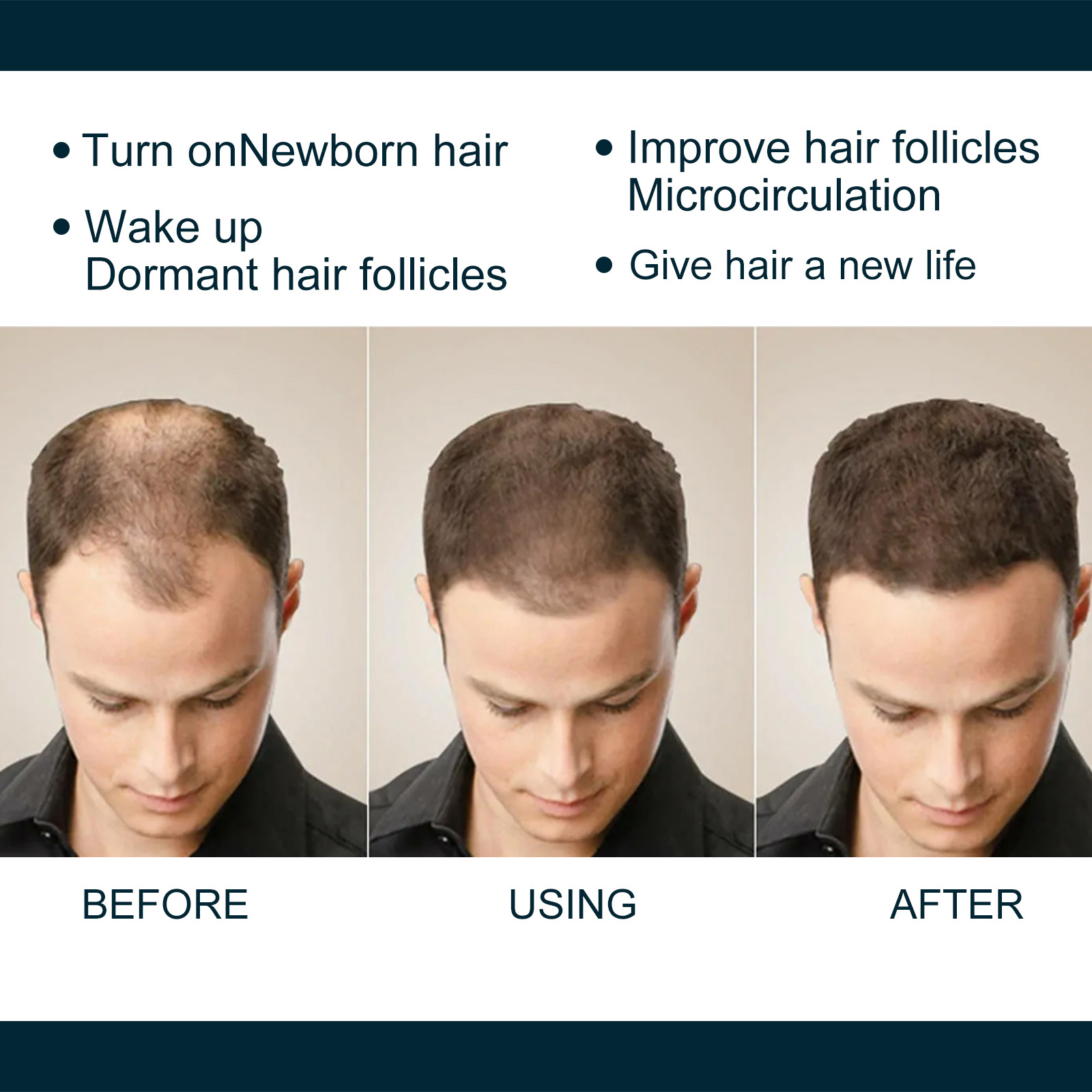 6pcs/box KIRLAND Hair Care Prevent Hair Loss Hair Growth Solution