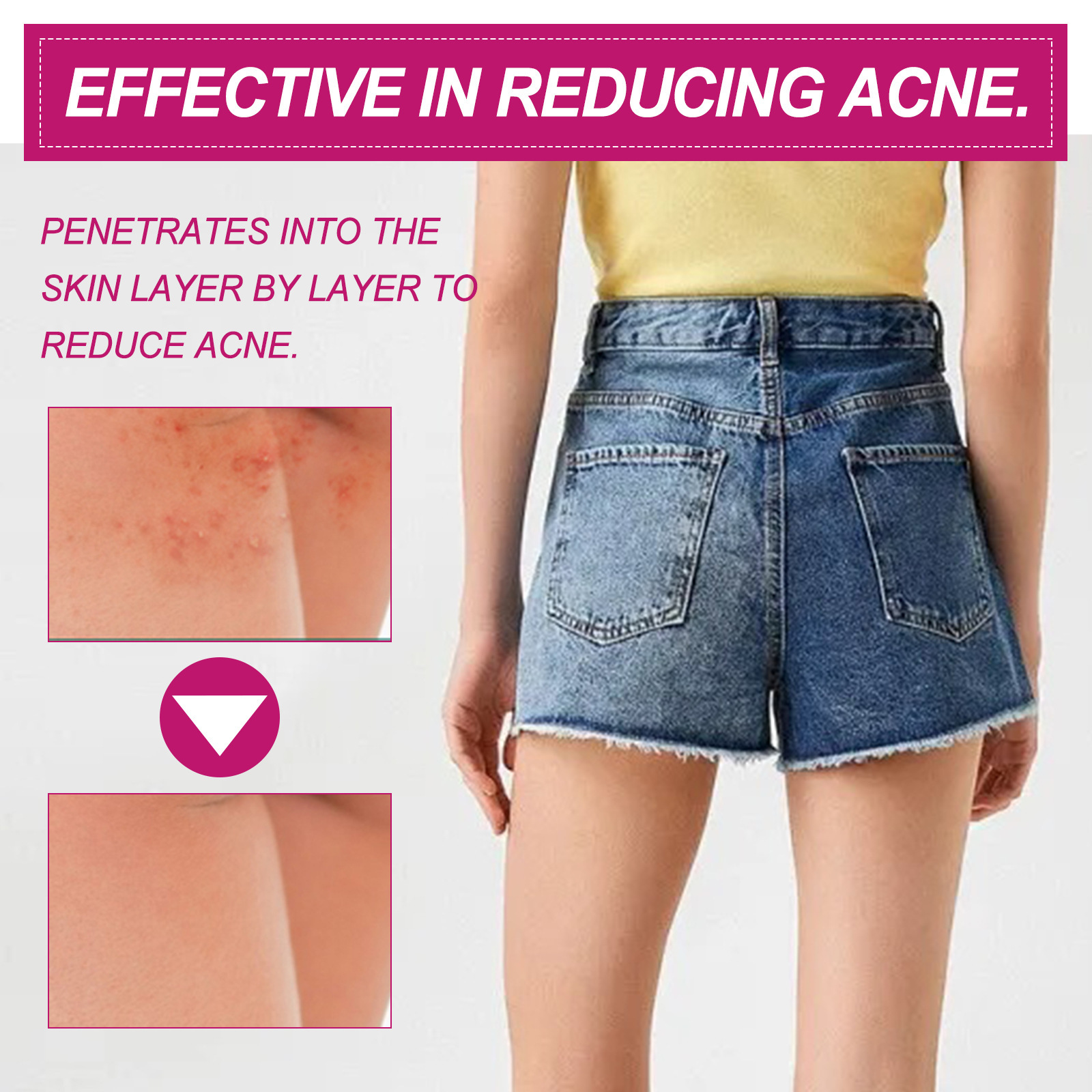 100ml Butt Acne Clearing Spot Treatment Cream Remove Pimples Moisturizing Skin Brighten Smooth Thigh Acne Removal Cream