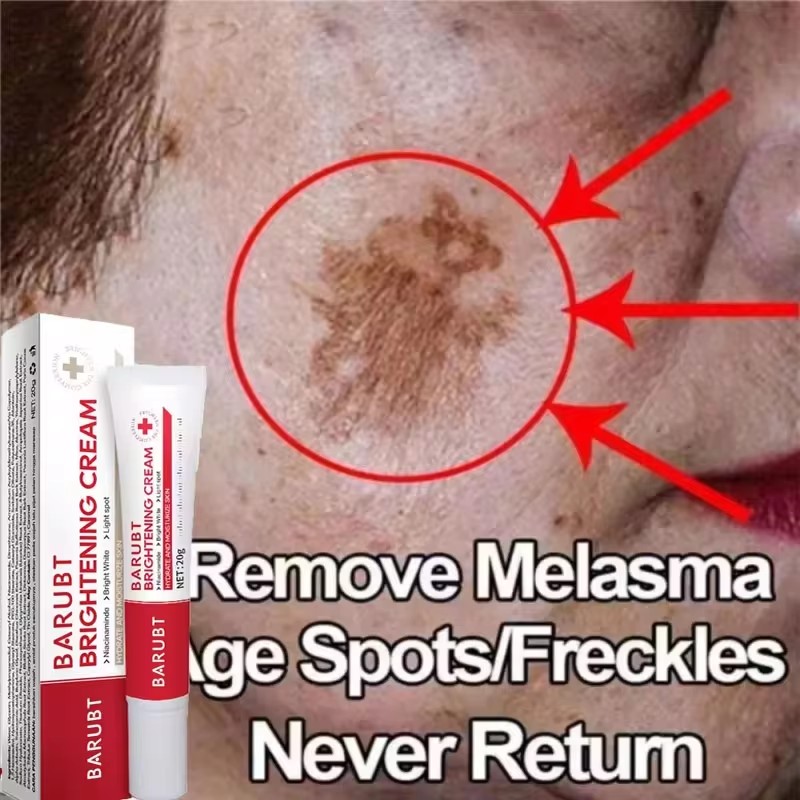 Powerful bleaching cream removing stains, lightens the skin, quickly removes melanin pigmentation, melasma, dark spots