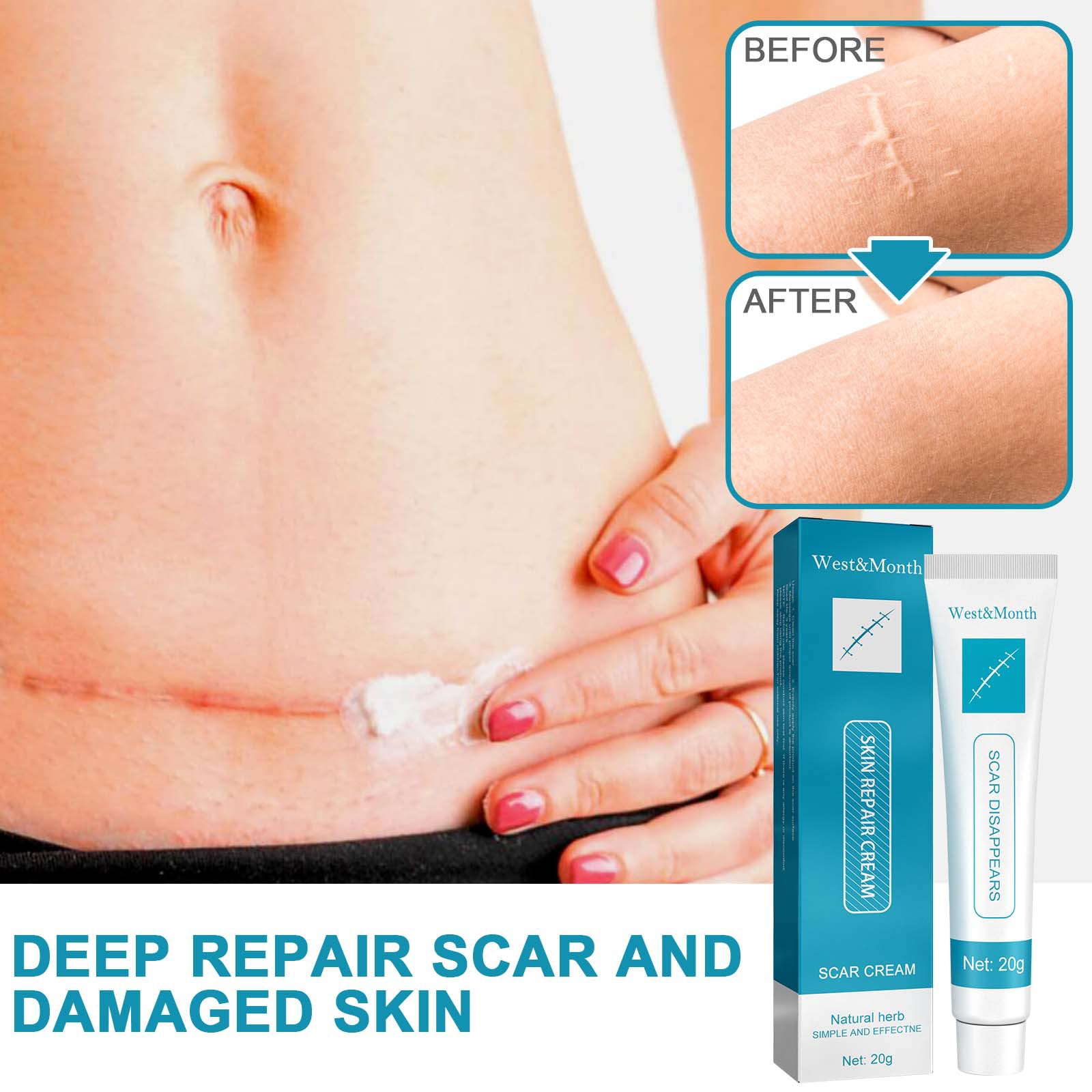 Herbal Scar Removal Cream Gel Stretch Marks Remove Acne Spots Burn Surgical Scars Treatment Smooth Whitening Face Body Skin Care