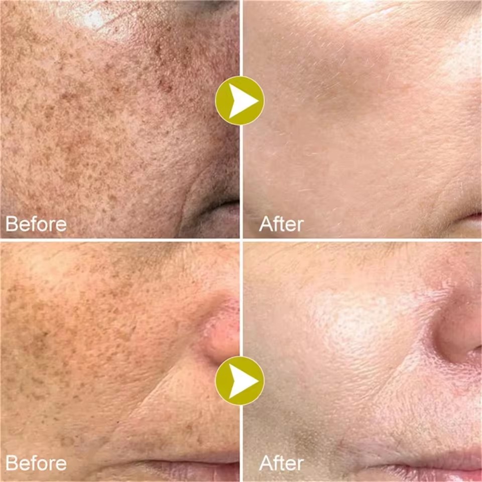 Powerful bleaching cream removing stains, lightens the skin, quickly removes melanin pigmentation, melasma, dark spots
