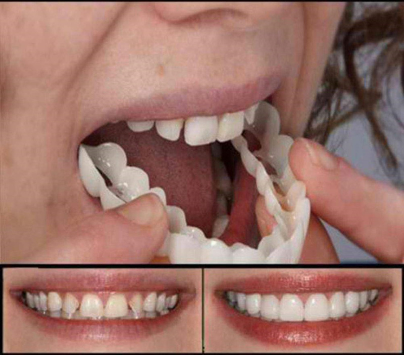 1PairThe Upper and Lower Veneer Teeth Whitening Denture Whitening Kit Is Currently Only Available for and Direct Sales