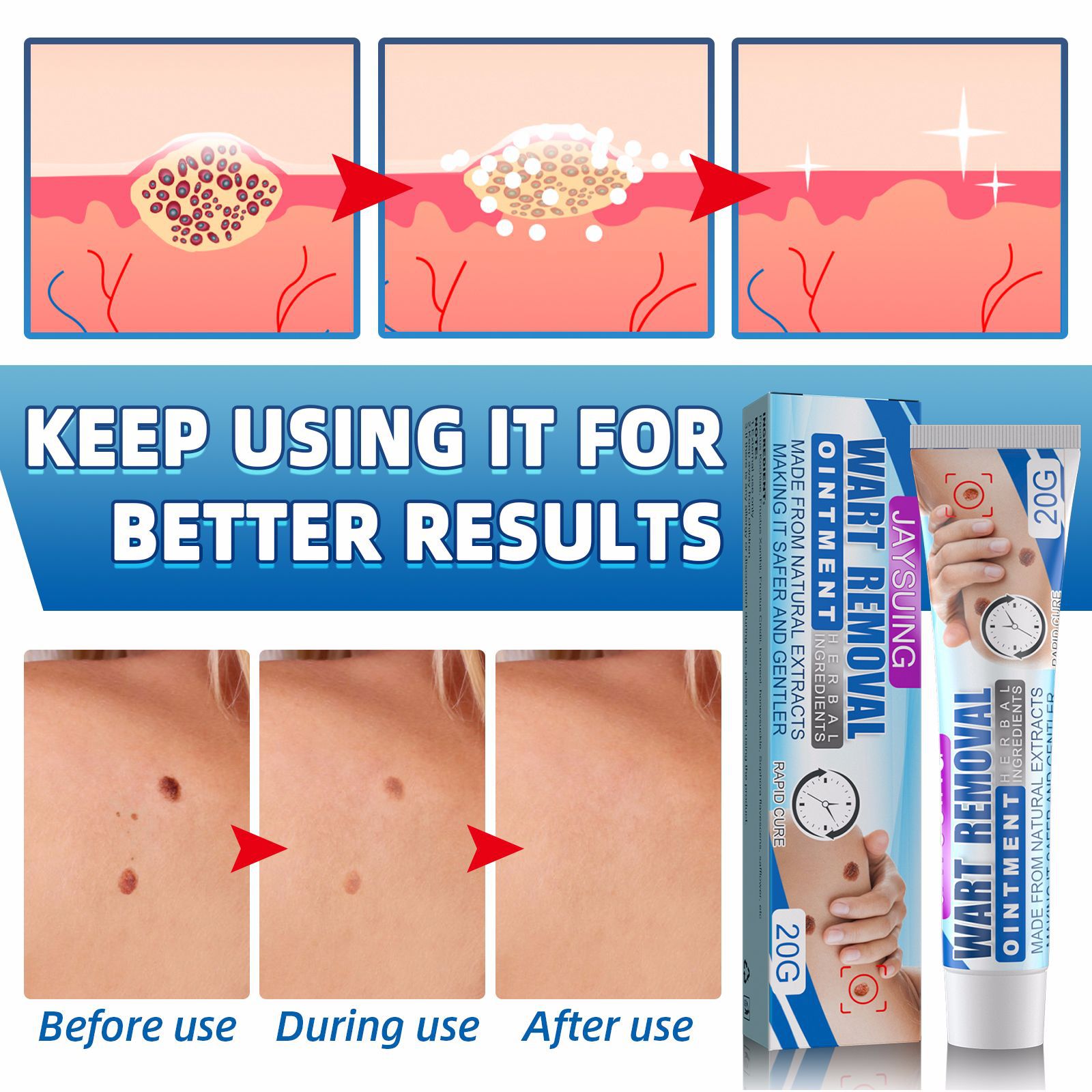 Wart Removal Treatment Antibacterial Ointment Papillomas Removing Skin Labels Flat Wart Genitals Painless Beauty Herbal Cream