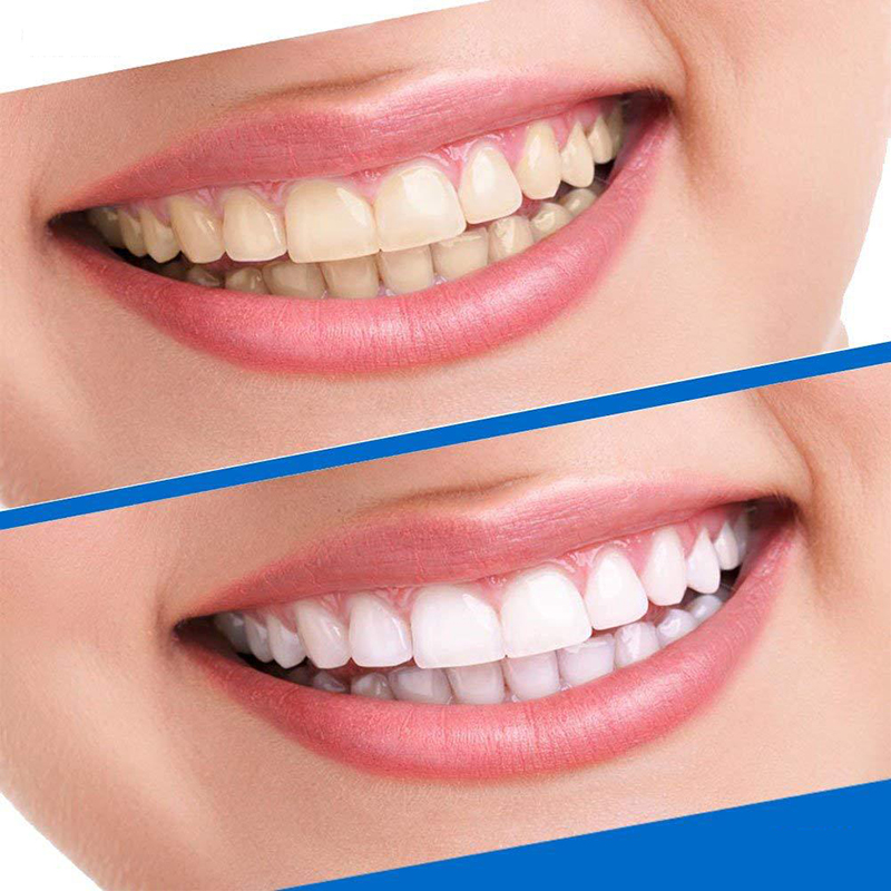 Teeth Whitening Strips Oral Hygiene Care Kit Stain Removal for Oral Hygiene Clean Double Elastic Dental Bleaching Strip14Pcs