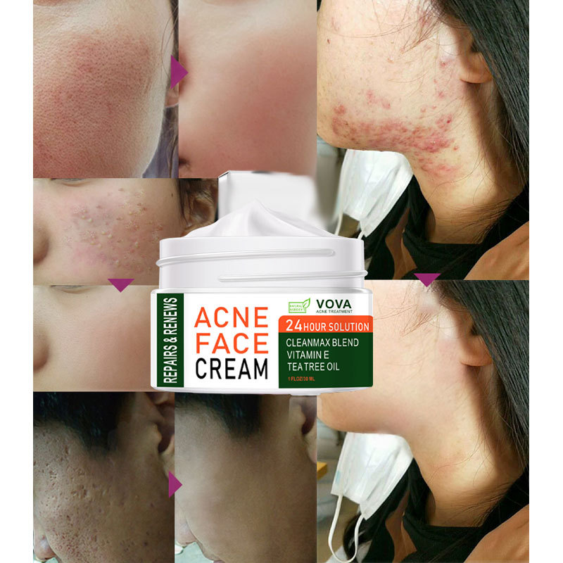 VOVA-Effective Acne Removal Cream Acne Spot Treatment Oil Control Pore Shrink Whitening Moisturizing Acne Skin Care Cream 30ml
