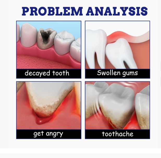 Toothache Stop Spray Mouth Ulcers Swollen Tooth Mouth Pain Tooth Decay No Burning Or Numbness Benzocaine And Free Mouth Ulcer20m