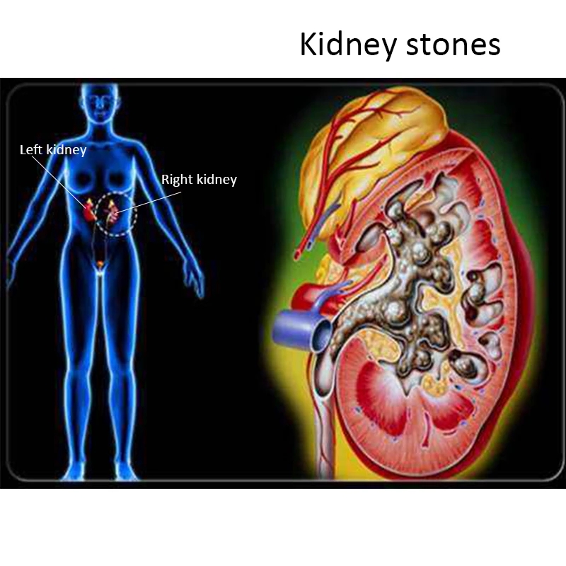 20 pcs/1 Packs Kidney Stones Cleaning Drink Tea Chinese medicine Kidney Care treatment Excreting kidney toxins cleaning product