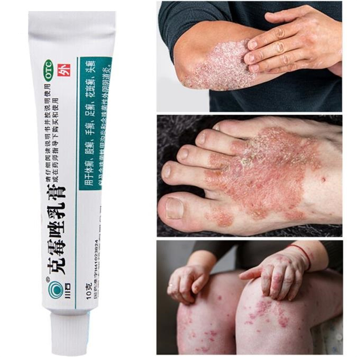 Herbal Antibacterial Cream Psoriasis Cream Anti-itch Relief Eczema Skin Rash Urticaria Desquamation Treatment