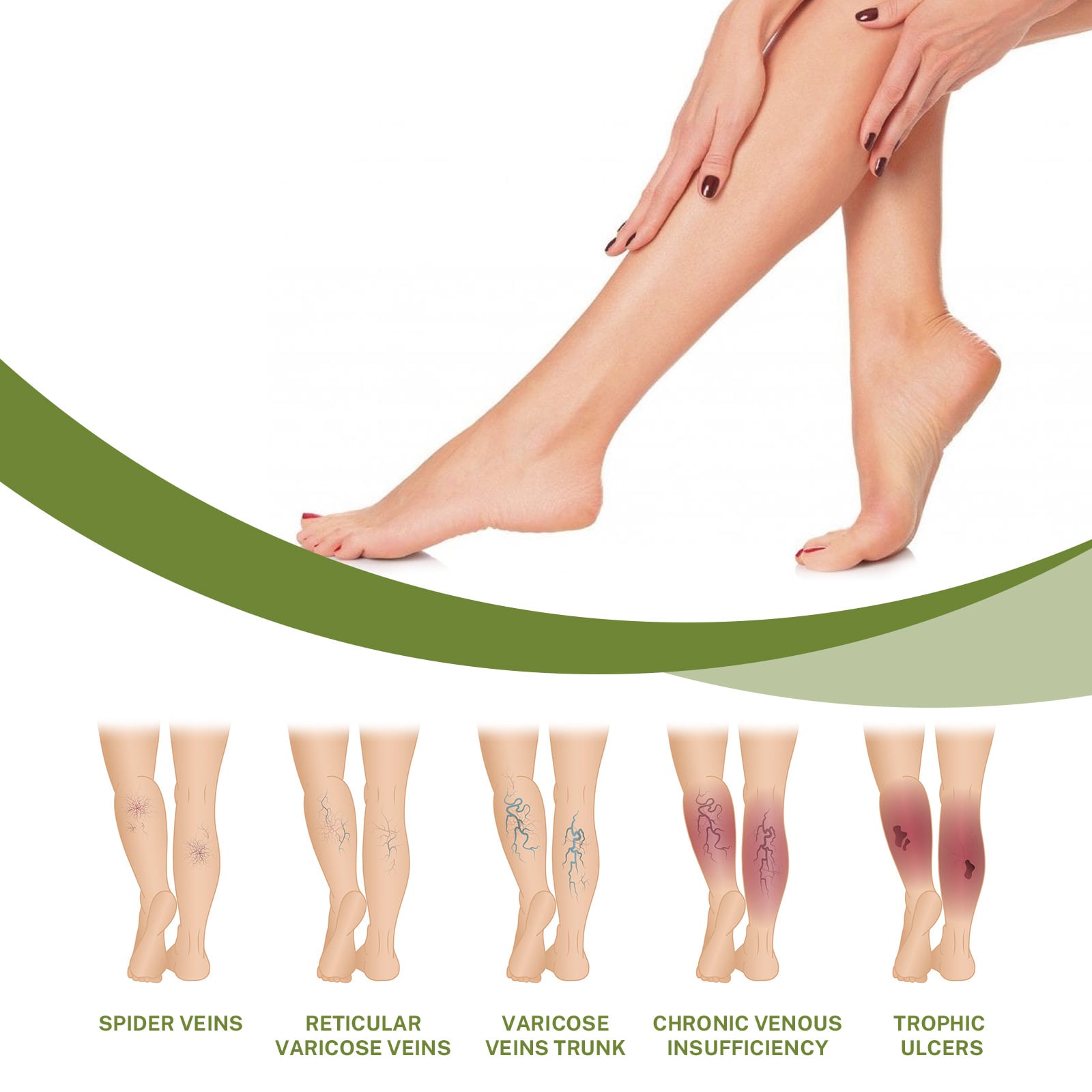Portable Varicose Vein Repair Cream Tongmai Effective Relieves Legs Bulge Pains Treatment Cream Vasculitis Phlebitis Remove Vein