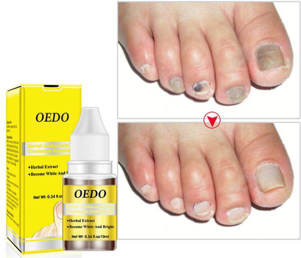 OEDO effective natural oil nail polish liquid repair treatment nail toe fungus removal moisturizing nail foot care essential oil