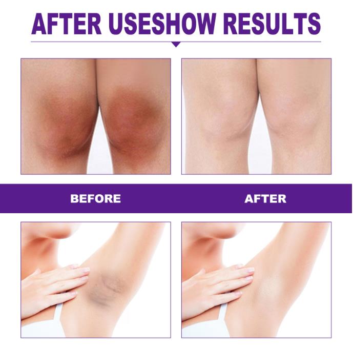 Private Parts Whitening Cream Underarm Bleaching Serum Whiten Butt Knee Brighten Inner Thigh Intimate Parts Dark Remove Melanin