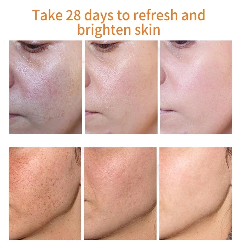 Whitening Freckle Cream Remove Melasma Cream Remove Dark Spots Melanin Melasma Remover Brighten Skin Anti-Aging Skin Lightening