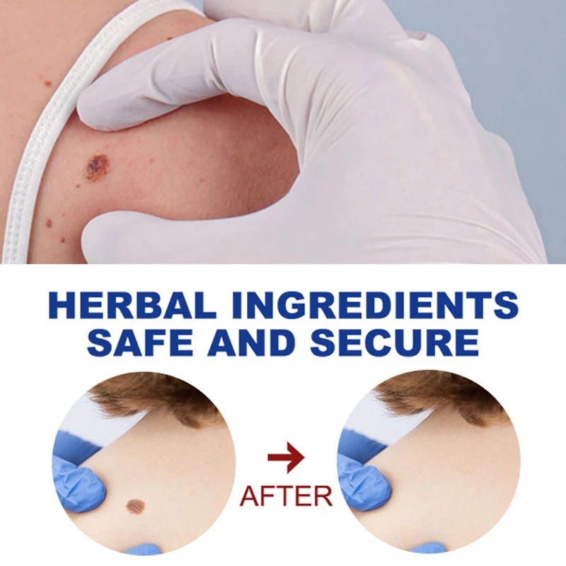 Wart Removal Mole Remedy Liquid Pen Treatment Papillomas Removing Skin Labels Flat Wart Genitals Painless Beauty Herbal Cream