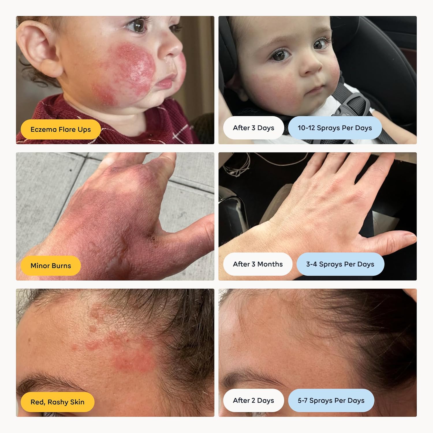 Magic Molecule Skin Cleanser for All Types, Hypochlorous Acid Spray Helps Heal Acne Prone, Eczema and Itchy Rashes and 50 Other Skin Ailments, 8 oz Sp