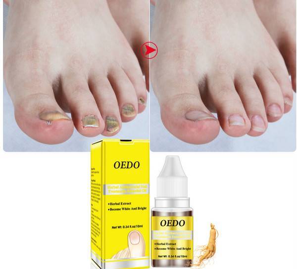 OEDO effective natural oil nail polish liquid repair treatment nail toe fungus removal moisturizing nail foot care essential oil