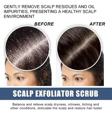 Fast Anti Exfoliating Scrub Remove Dandruff Anti Itching Treatment Seborrheic Scalp Oil Control Repair Scalp Beauty Health Care