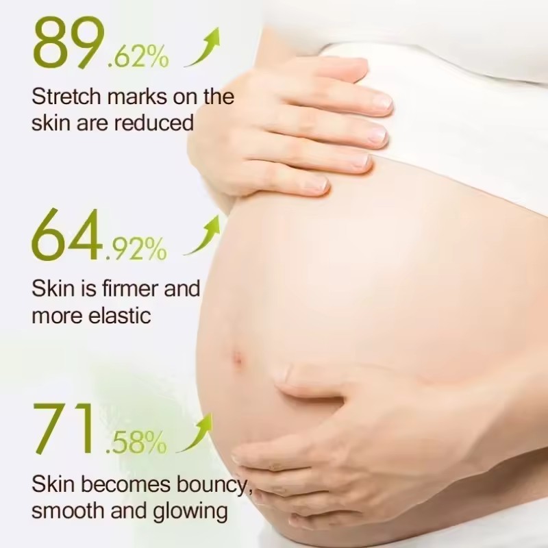 1PC Stretch Mark Vanishing Cream Remove Body Buttock Breast Marks Effective Treatment Repair Maternity Loose Firming Skin Care