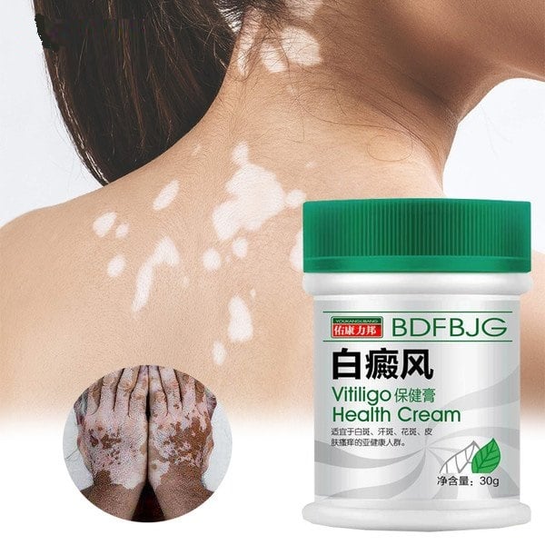 30G Vitiligo cream Antibacterial cream Psoriasis Localised Vitiligo Zalf White spot Mycosis Leucoplasia Treatment P1153