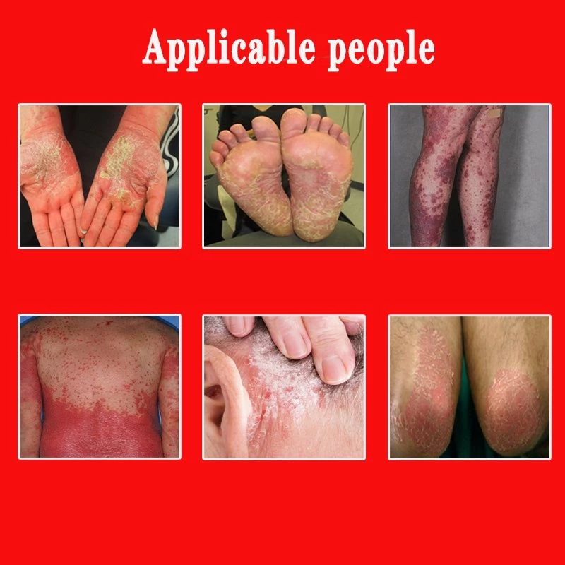 15gm Herbal Krim Kulit Badan(Sesuai Utk Semua Kulit/Gatai/Allergi)