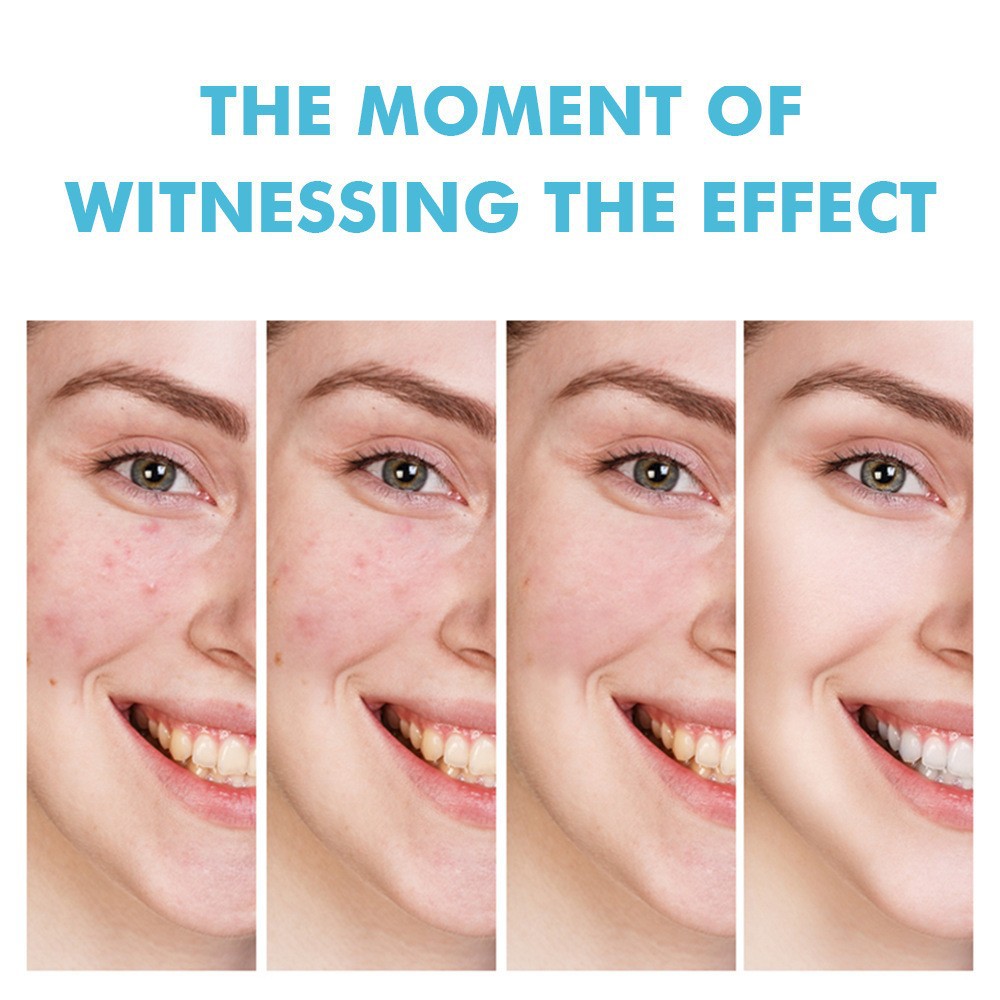Salicylic Acid Acne Removing Cream Acne Removing Cream Soothes Lightens Acne Marks Gently Repairs Skin Care Moisturizes Cream
